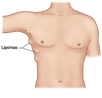 lipoma2_13_20110307122717_767.jpg